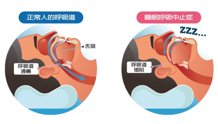 睡眠呼吸中止