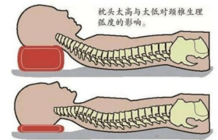 落枕是什麼